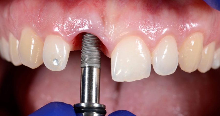 Trong Rang Implant Nha Khoa Toan Cau