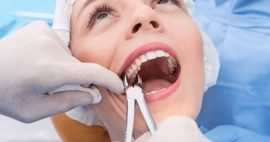 Nhổ răng khôn an toàn và không đau