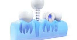 Giá cấy ghép implant có đắt không?