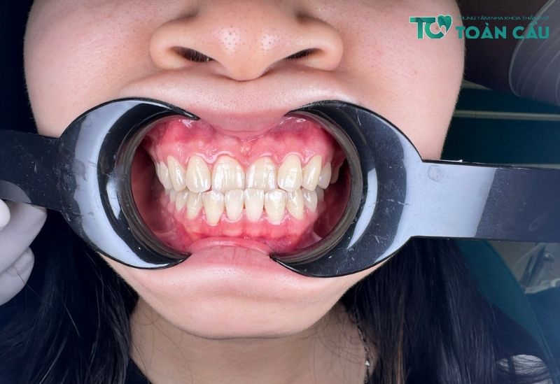 Lợi ích niềng răng trong sinh hoạt người bệnh