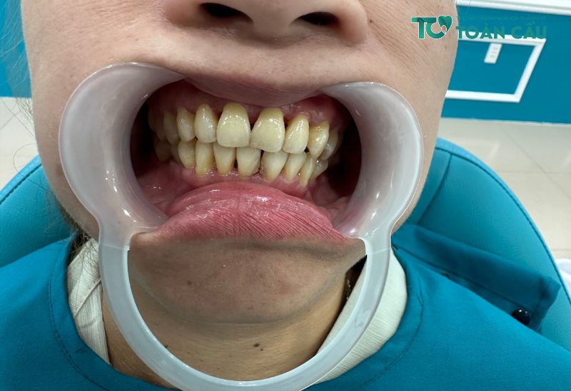 Bầu có tẩy trắng răng được không?