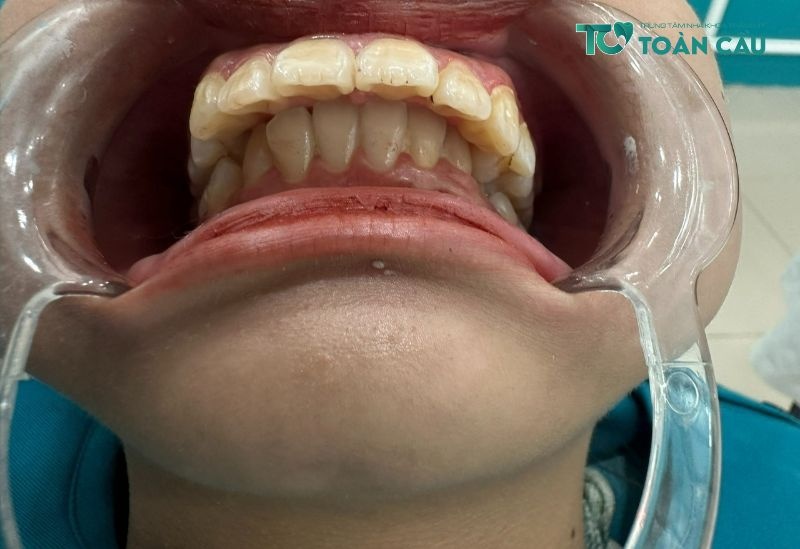 Những trường hợp nào cần nhổ răng số 4 khi niềng răng