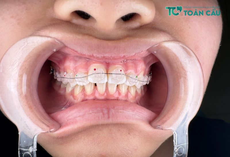 Những trường hợp không cần nhổ răng khi niềng răng