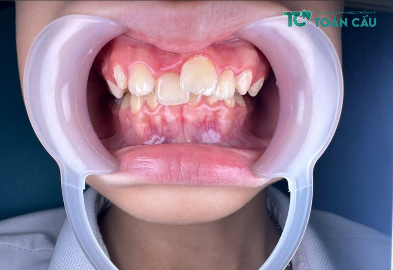 Niềng răng cho bé 7 tuổi giúp cải thiện chức năng ăn nhai