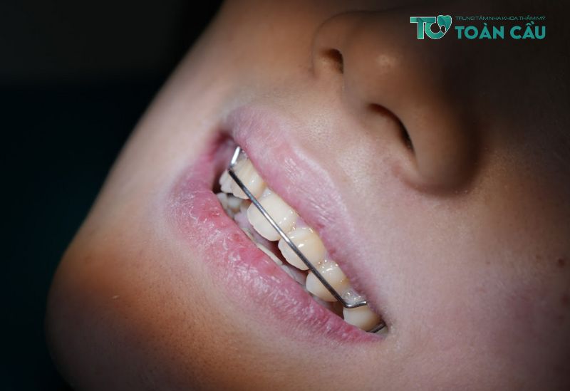 Phương pháp niềng răng cho bé 7 tuổi hiệu quả, an toàn