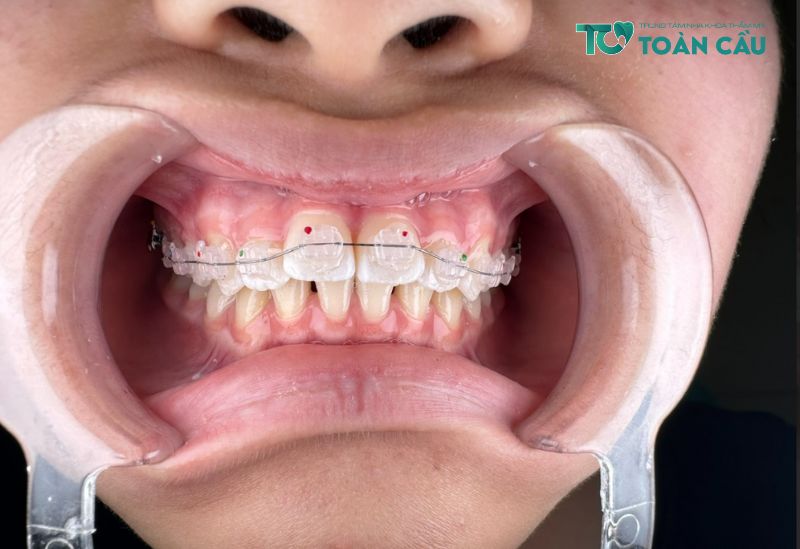 Niềng răng có cần nhổ răng khôn không?