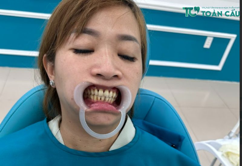 Khi nào nên tẩy trắng răng Gò Vấp?