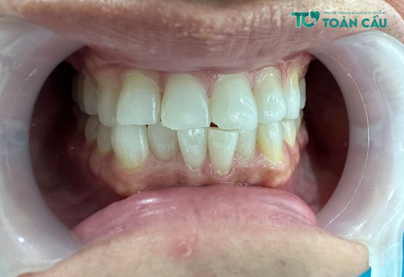 Tẩy trắng răng ở đâu tốt và uy tín nhất tại TPHCM?