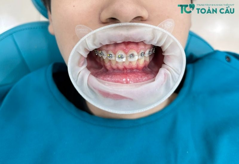 Phương pháp niềng răng khi bị mất răng