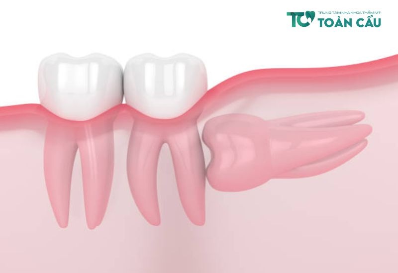 Nguyên nhân dẫn đến tình trạng nhổ răng số 8 còn sót chân răng