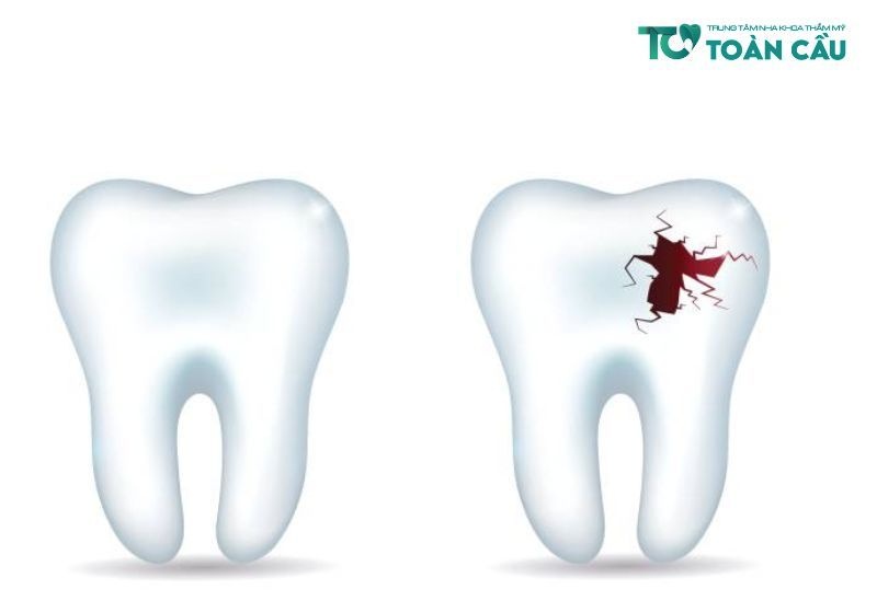 Nhổ răng cửa có nguy hiểm không? Các trường hợp nên nhổ răng cửa