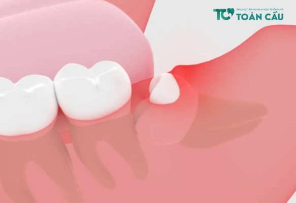 Nhổ răng khôn còn sót chân răng có sao không?