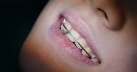 Chi phí niềng răng mắc cài kim loại giá rẻ bao nhiêu tiền?