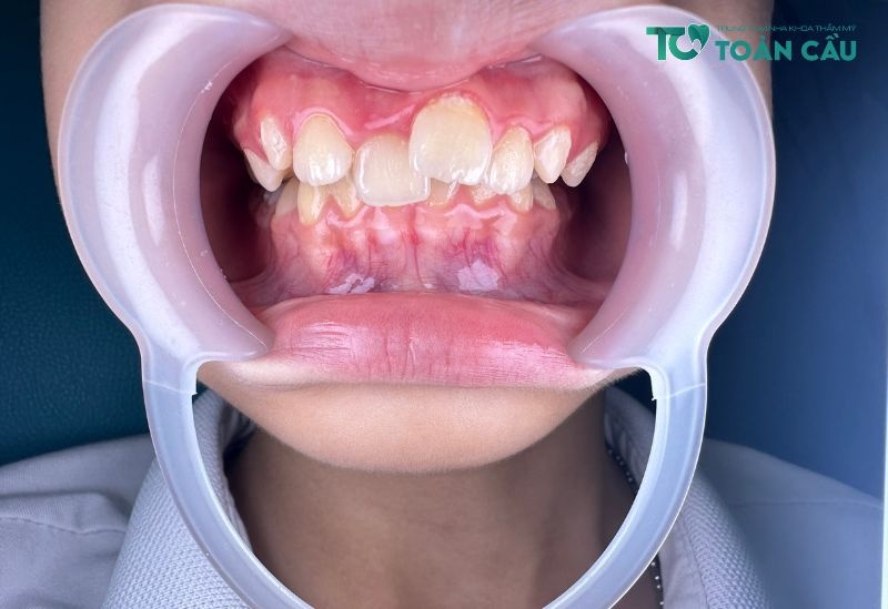 Niềng răng trong suốt có đau không? Những trường hợp nên niềng răng trong suốt