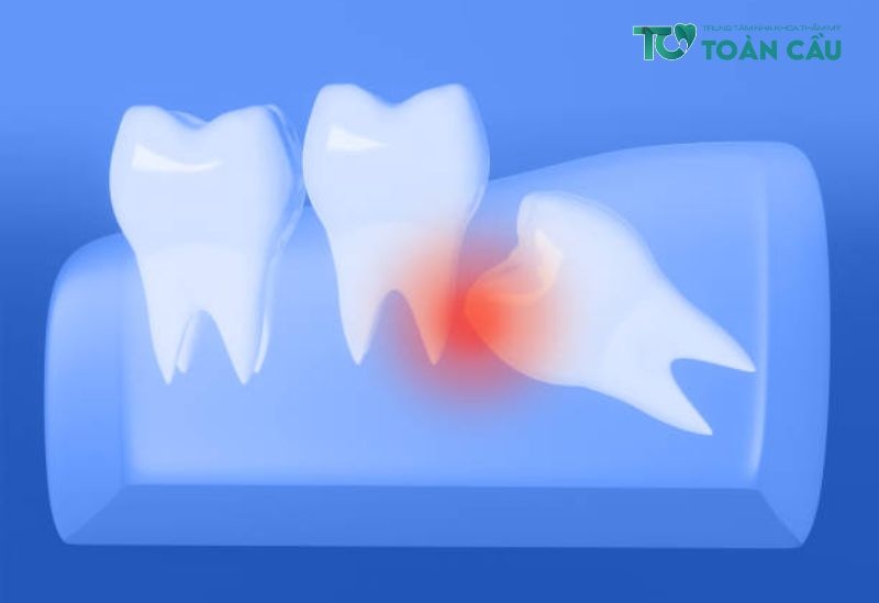 Nhổ răng khôn mọc ngang và đặc điểm của răng khôn
