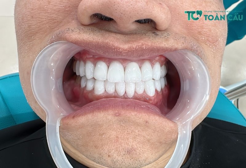 Các nguyên nhân khiến răng bị bể, vỡ, nứt