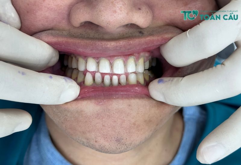 Nguyên nhân răng sứ bị hở là gì?