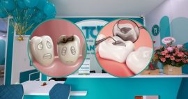 Trám răng ở đâu tốt TPHCM? Địa chỉ trám răng giá rẻ, hiệu quả