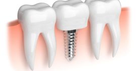 Trồng răng implant HCM ở đâu an toàn, chất lượng?