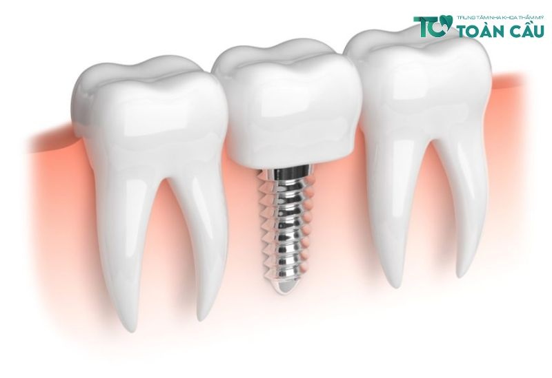 Trồng răng implant HCM ở đâu an toàn, chất lượng?