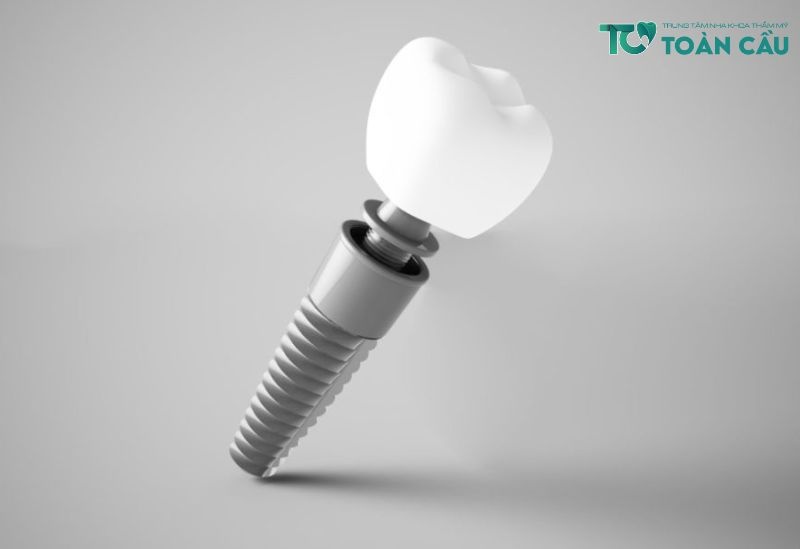 Trồng răng implant HCM là gì?