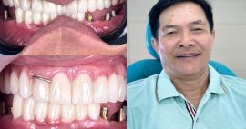 Địa chỉ làm hàm tháo lắp