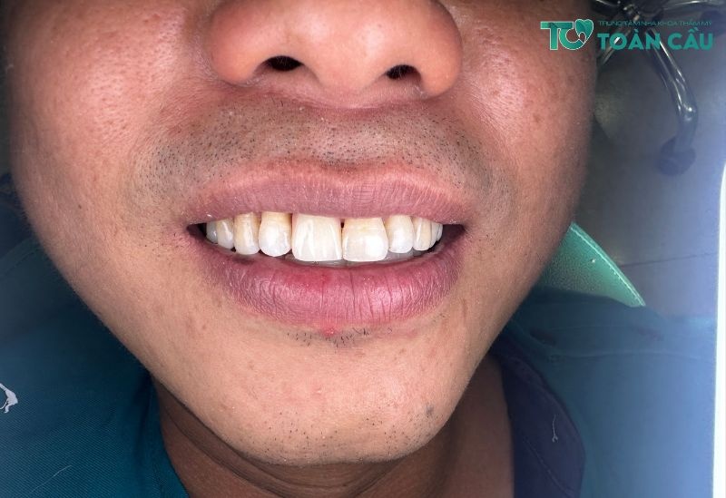 Trồng răng implant có nguy hiểm không?