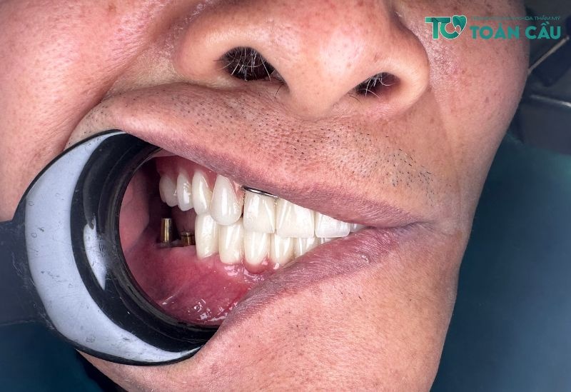 Tìm hiểu thông tin về phương pháp trồng răng implant