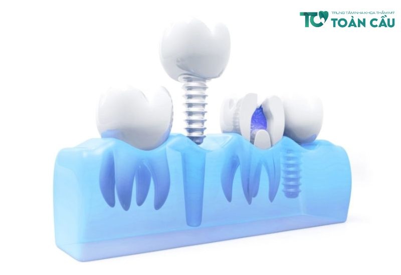 Cham Soc Rang Sau Cay Ghep Implant (1)