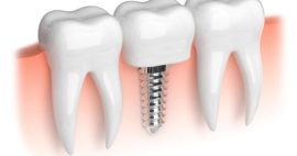 Thoi Gian Trong Rang Implant (1)