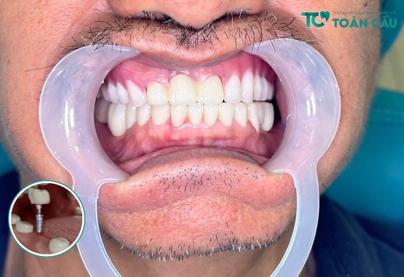 Trong Rang Implant Khong Dau (2)