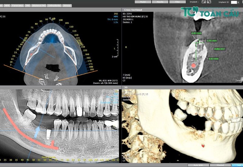 Trong Rang Implant Khong Dau (3)