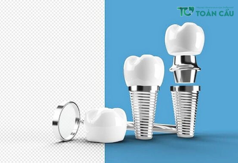 Trong Rang Implant Khong Dau (4)