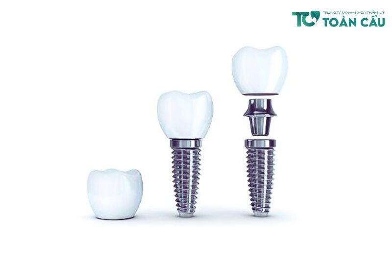 Tru Implant Hiossen (4)