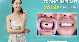 Nha khoa trồng Implant Gò Vấp - Hướng dẫn chăm sóc chi tiết