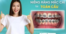 Bật mí địa chỉ niềng răng mắc cài Gò Vấp uy tín