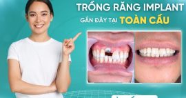 Trồng răng Implant gần đây ở đâu chất lượng nhất