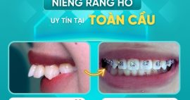 Niềng răng hô hàm trên - Giải pháp cho nụ cười rạng rỡ