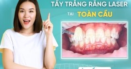 Có nên tẩy trắng răng bằng laser? Có hiệu quả không?