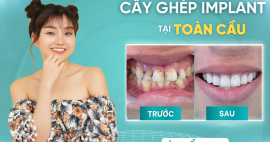 Giải đáp cấy ghép implant ở đâu Gò Vấp để có giá rẻ nhất