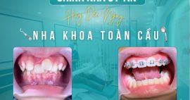 Chỉnh nha Gò Vấp - Lựa chọn Nha Khoa Toàn Cầu uy tín nhất