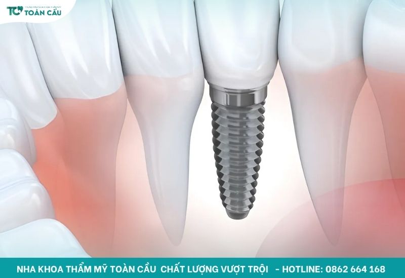 Trồng răng Implant giải pháp cho tình trạng mất răng