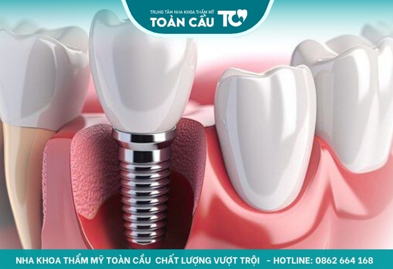 Trồng răng bằng phương pháp Implant