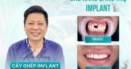 Cầu răng trên trụ implant là giải pháp dành cho người mất răng