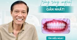 Khám phá địa chỉ trồng Implant gần nhất tại khu vực TP. HCM
