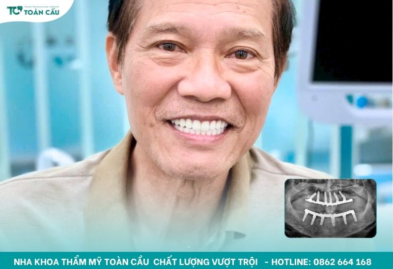 Trồng răng implant sẽ là giải pháp an toàn cho người lớn tuổi
