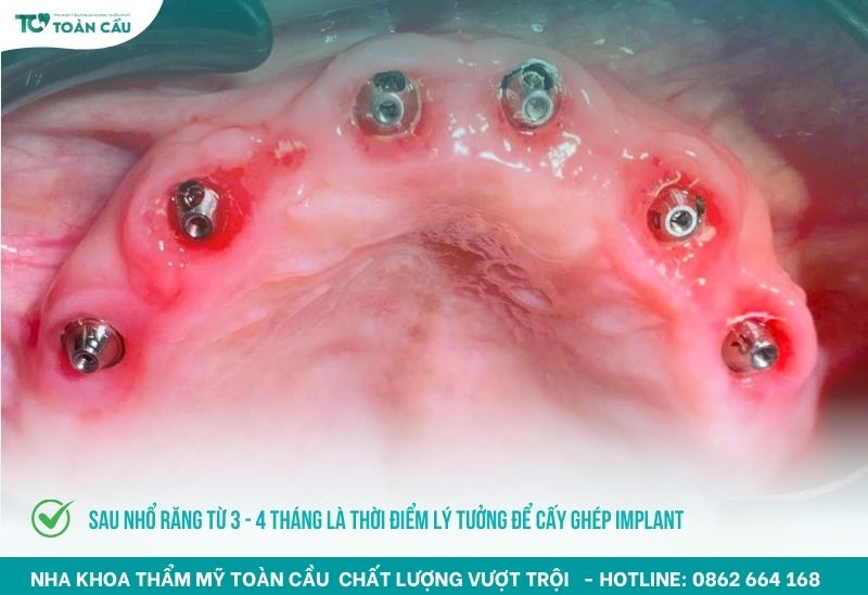 Sau nhổ răng từ 3 - 4 tháng là thời điểm lý tưởng để cấy ghép implant