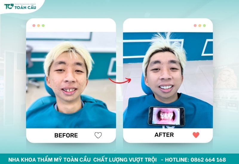Thẩm mỹ Toàn Cầu – nha khoa cấy ghép implant gần đây uy tín