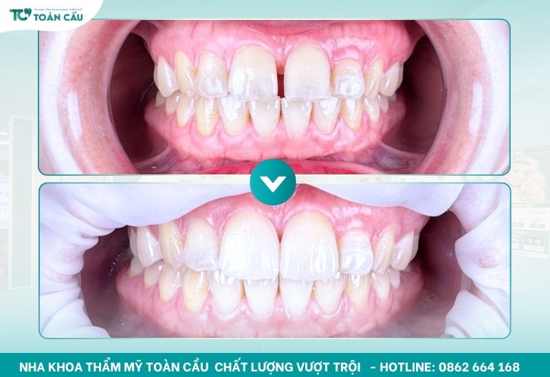Dán răng sứ Veneer là một giải pháp tiên tiến trong nha khoa