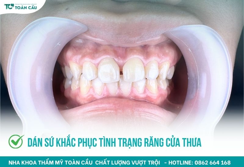 Dán sứ khắc phục răng cửa mọc thưa